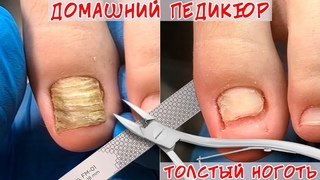 Как подстричь толстые ногти на ногах / Толстый ноготь на ноге, что делать