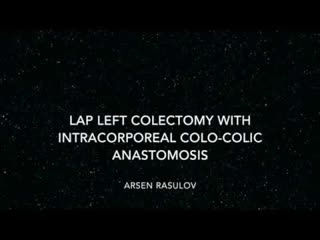 Lap left colectomy with intracorporeal colo-colic anastomosis
