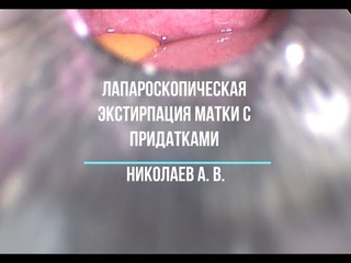 Лапароскопическая экстирпация матки с придатками